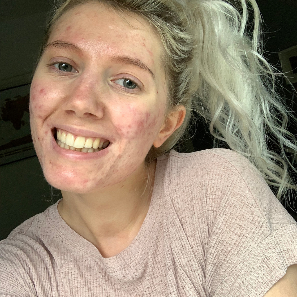Guest blog by Kara Olivia, My Acne journey, what has helped me with Self Love and Positivity